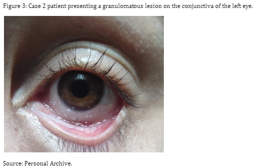 Figure 3: Case 2 patient presenting a granulomatous lesion on the conjunctiva of the left eye.